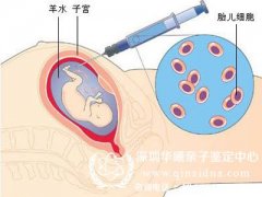 羊水穿刺验亲子关系准确率多少