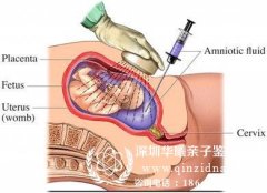 羊水穿刺就可以做亲子鉴定吗