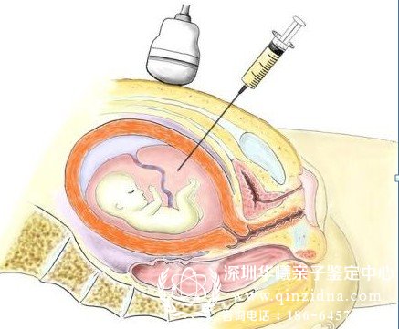 羊水穿刺示意图