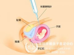 胎儿亲子鉴定抽取羊水时要打麻醉针吗