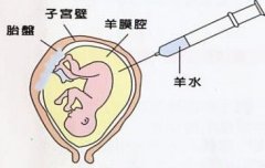 什么是羊膜穿刺亲子鉴定？