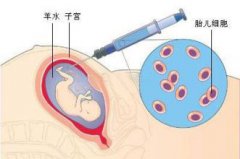 羊膜穿刺和羊水穿刺是一样的吗